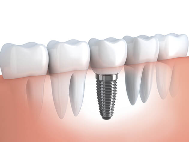 Dental Implant Indianapolis