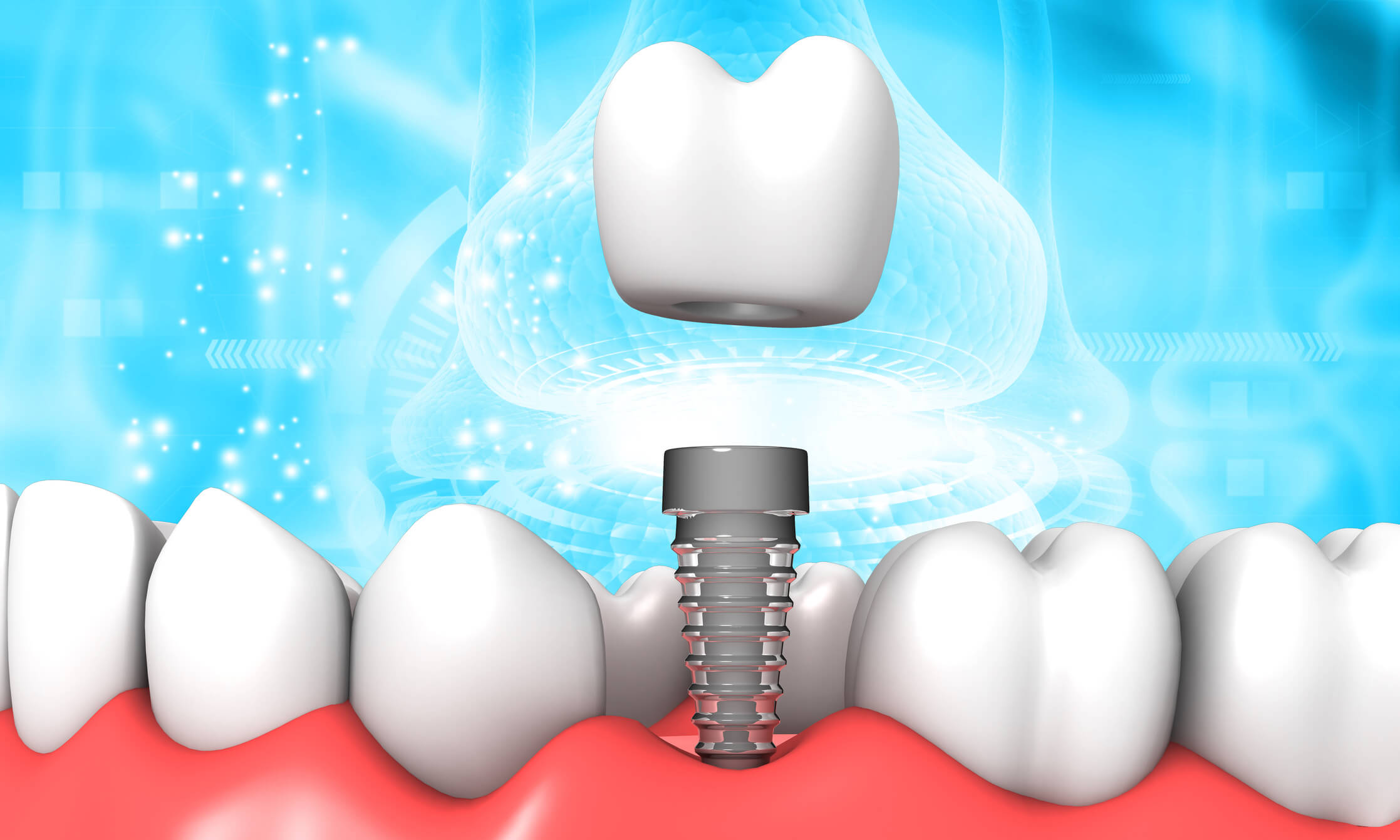 Single vs. Full Mouth Implants